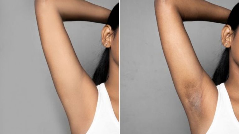 Dark Underarms Remedies