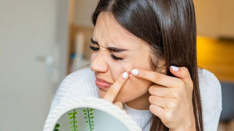 DIY Tips For Pimple