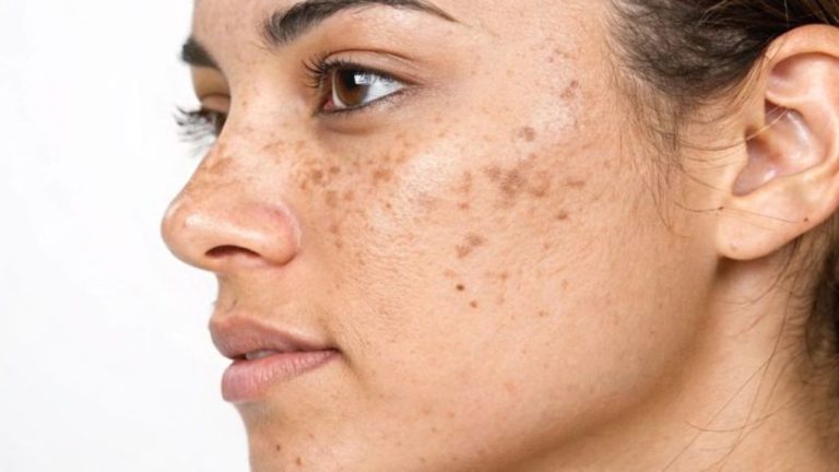 Remedies For Pigmentation
