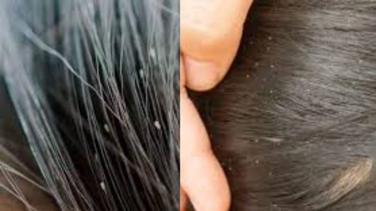 Home Remedies For Lice In Hair