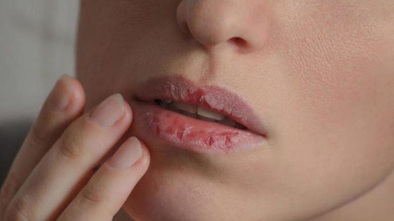 Lip Care In Summer: