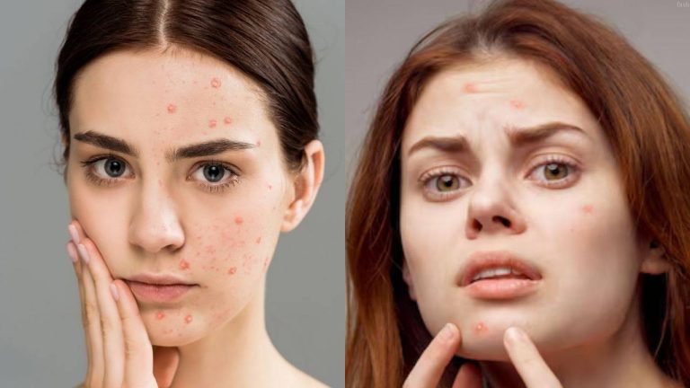Pimple Acne Tips