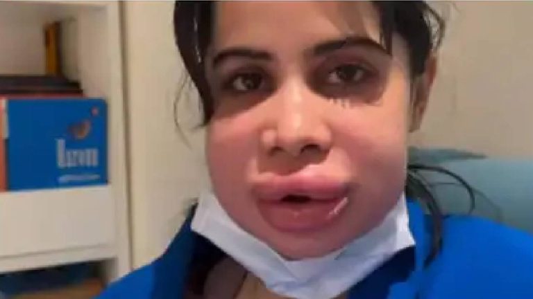 Lip Fillers Side Effects