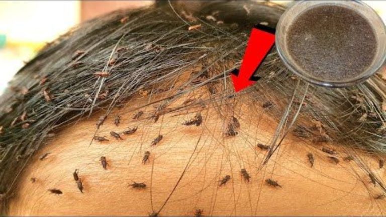 Home Remedies For Lice