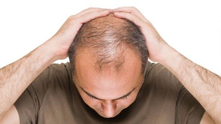 Tips & Tricks For Baldness