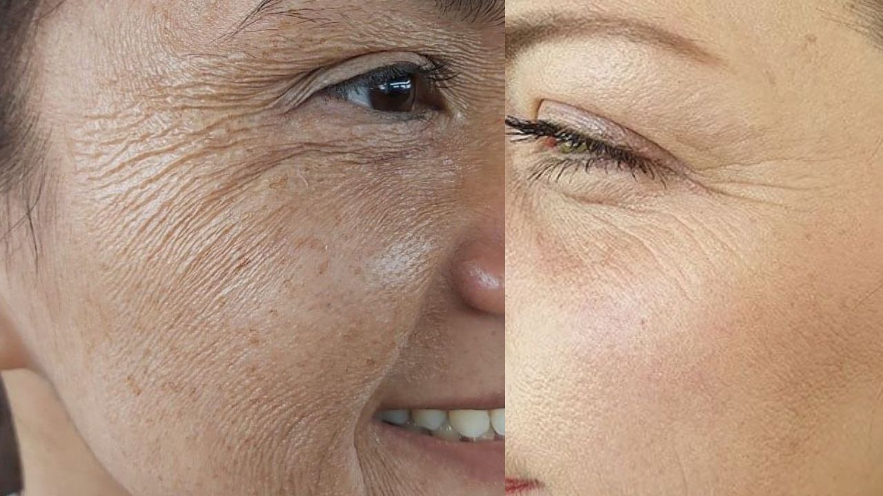 Cause Of Wrinkles