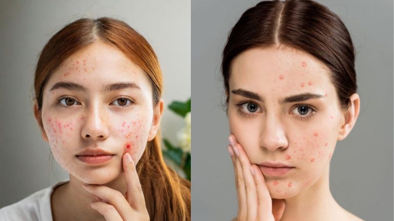Home Remedies For Pimples