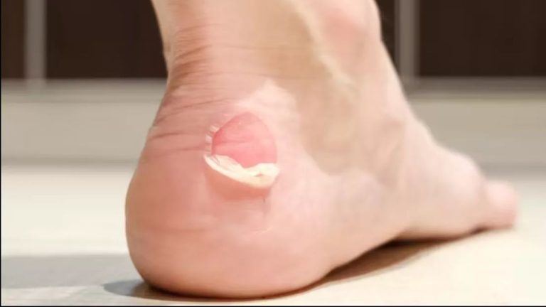Tips To Avoid Shoe Bites