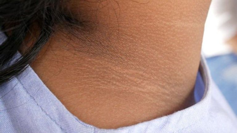 Dark Neck Home Remedies