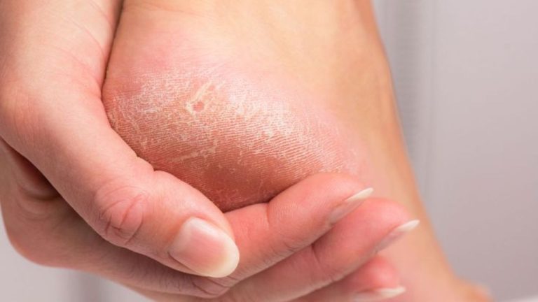 Cracked Heels