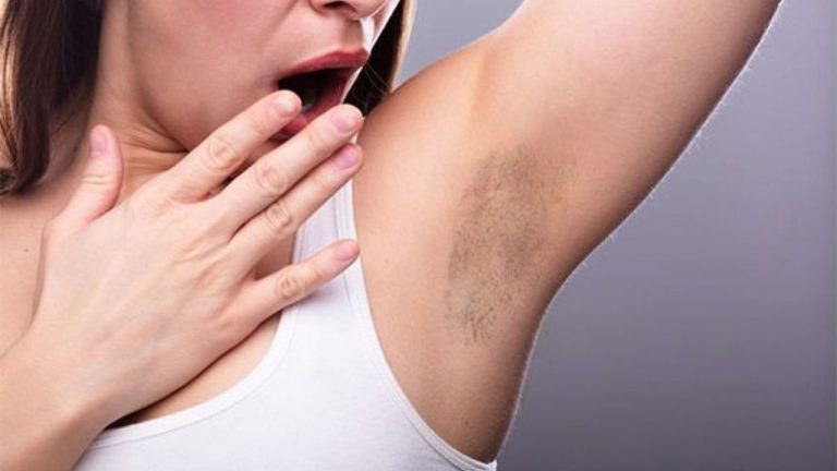 Underarm Hair Removal: