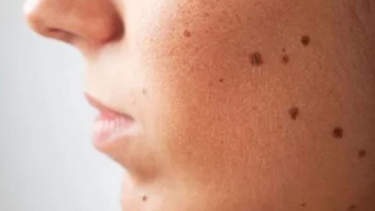 Home Remedies For Moles: