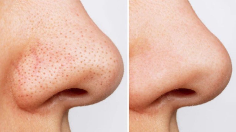Blackheads Removal Tips